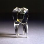 Audio Tooth Implant
