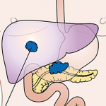 Implantable Device to Deliver Drugs to Pancreatic Cancer Tumors