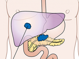 Implantable Device to Deliver Drugs to Pancreatic Cancer Tumors
