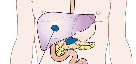 Implantable Device to Deliver Drugs to Pancreatic Cancer Tumors