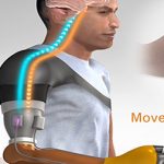 Restoring Movement Sensation in Patients with Upper Limb Amputation movement sensation