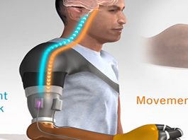 Restoring Movement Sensation in Patients with Upper Limb Amputation movement sensation