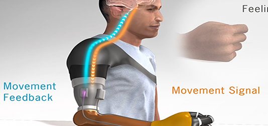 Restoring Movement Sensation in Patients with Upper Limb Amputation movement sensation