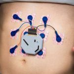 Wearable Stomach Monitor Tracks Electrical Activity for Signs of Indigestion stomach monitor