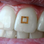 This Tiny Tooth Sensor Could Track Your Diet and Health tooth sensor