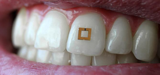 This Tiny Tooth Sensor Could Track Your Diet and Health tooth sensor