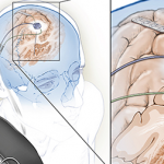 New Method of Deep Brain Stimulation Adapts to Patient’s Changing Needs Deep brain stimulation