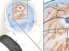 New Method of Deep Brain Stimulation Adapts to Patient’s Changing Needs Deep brain stimulation