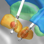 CRC 1261 Research on Developing Biomagnetic Diagnostics System to Continuously Adjust Deep Brain Stimulation Deep brain stimulation