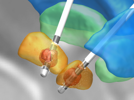 CRC 1261 Research on Developing Biomagnetic Diagnostics System to Continuously Adjust Deep Brain Stimulation Deep brain stimulation