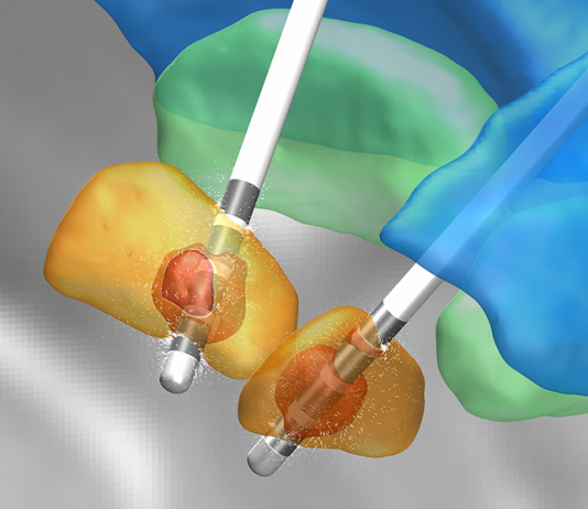 CRC 1261 Research on Developing Biomagnetic Diagnostics System to Continuously Adjust Deep Brain Stimulation Deep brain stimulation