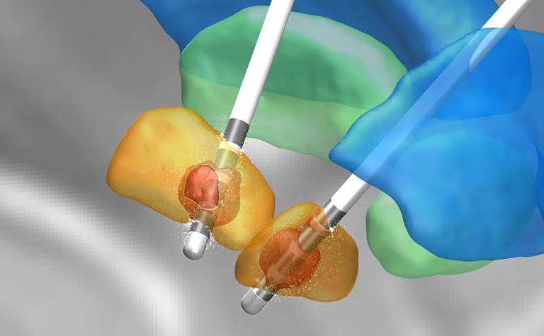 Deep brain stimulation