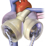 SynCardia Temporary Total Artificial Heart Shows Clear Life-Saving Efficiency: Study SynCardia TAH