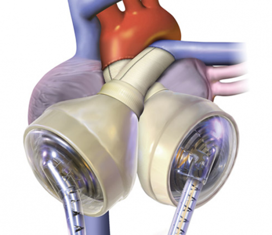 SynCardia Temporary Total Artificial Heart Shows Clear Life-Saving Efficiency: Study SynCardia TAH
