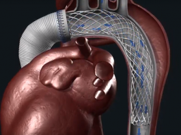 Ascyrus Medical’s Ascyrus Medical Dissection Stent (AMDS) Gets CE Mark Approval Ascyrus Medical Dissection Stent