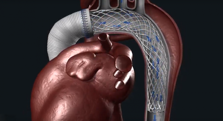 Ascyrus Medical Dissection Stent