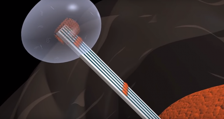 Brain tumor pied piper device