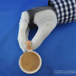 Swedish Woman Receives First Dexterous and Sentient Prosthetic Hand Dexterous, Sentient Prosthetic Hand