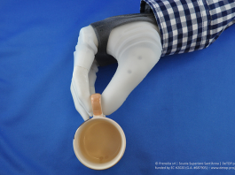 Swedish Woman Receives First Dexterous and Sentient Prosthetic Hand Dexterous, Sentient Prosthetic Hand