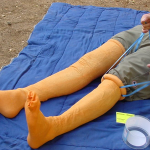 HemaShock: Emergency Auto-Transfusion Tourniquet Can Save Lives from Heart Attacks and Bleeding HemaShock Tourniquet