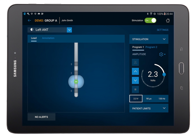 Medtronic DBS for epilepsy