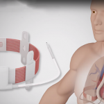 Leviticus Cardio and Jarvik Heart Unveil Groundbreaking Wirelessly Powered Heart Pump Wirelessly Powered Heart Pump