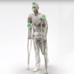 OSSIO Developing Absorbable Fixation Devices that Promotes Bone Growth and Removes Need for Surgery OSSIOfiber Implant System