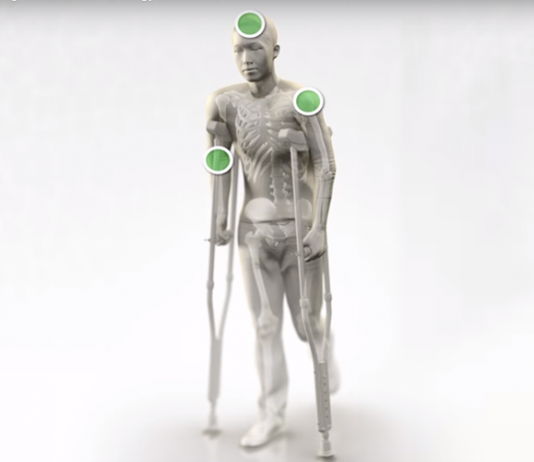 OSSIO Developing Absorbable Fixation Devices that Promotes Bone Growth and Removes Need for Surgery OSSIOfiber Implant System