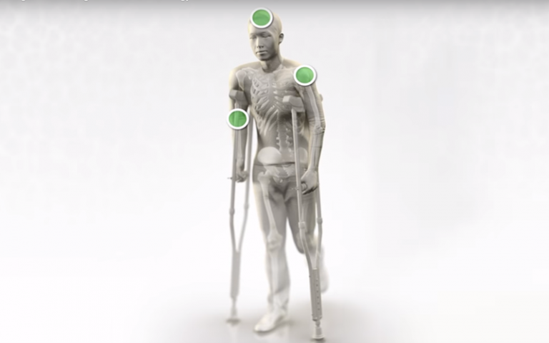 OSSIOfiber Implant System