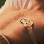 Isansys ‘Smart Patch’ Wireless Monitoring Platform Very Effective in Monitoring Patients with Advanced Liver Disease: Study Isansys Patient Status Engine