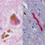 Wearables Should Replace Self-Reporting Diaries for Tracking Parkinson’s Symptom, Says New Study Wearables for Parkinsons study