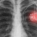South Korean Researchers Develop Method To Wirelessly Power Medical Implants Using Light Light photon to Power medical implants