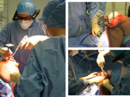 Pixee Medical Successfully Finishes its First Total Knee Replacement Surgery Guided Only by the Vuzix M400 AR Glasses Pixee medical Vuzix M400 Knee Surgery