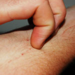 Wearable Sensor Can Measure Itching From Pediatric Eczema, Adult Itch Symptoms Wearable Sensor Measures Itching from Eczema