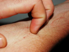 Wearable Sensor Can Measure Itching From Pediatric Eczema, Adult Itch Symptoms Wearable Sensor Measures Itching from Eczema