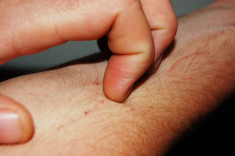 Wearable Sensor Measures Itching from Eczema