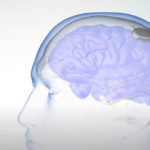 NeuroPace Develops Smart Wearable RNS System For The Treatment of Drug-Resistant Epilepsy NeuroPace RNS System for Epilepsy Treatment