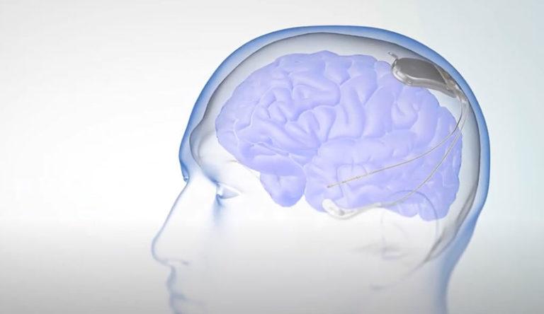 NeuroPace RNS System for Epilepsy Treatment