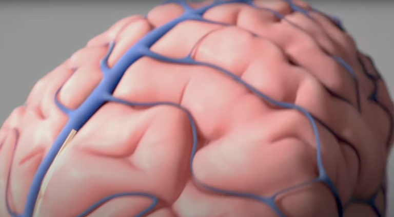 Synchron clinical trial on Stentrode